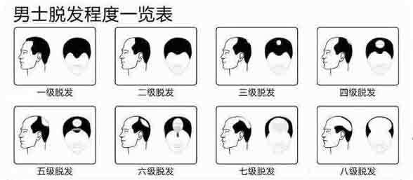 越来越多年轻人被脱发困扰：00后开始植发90后已戴上假发片(图2)
