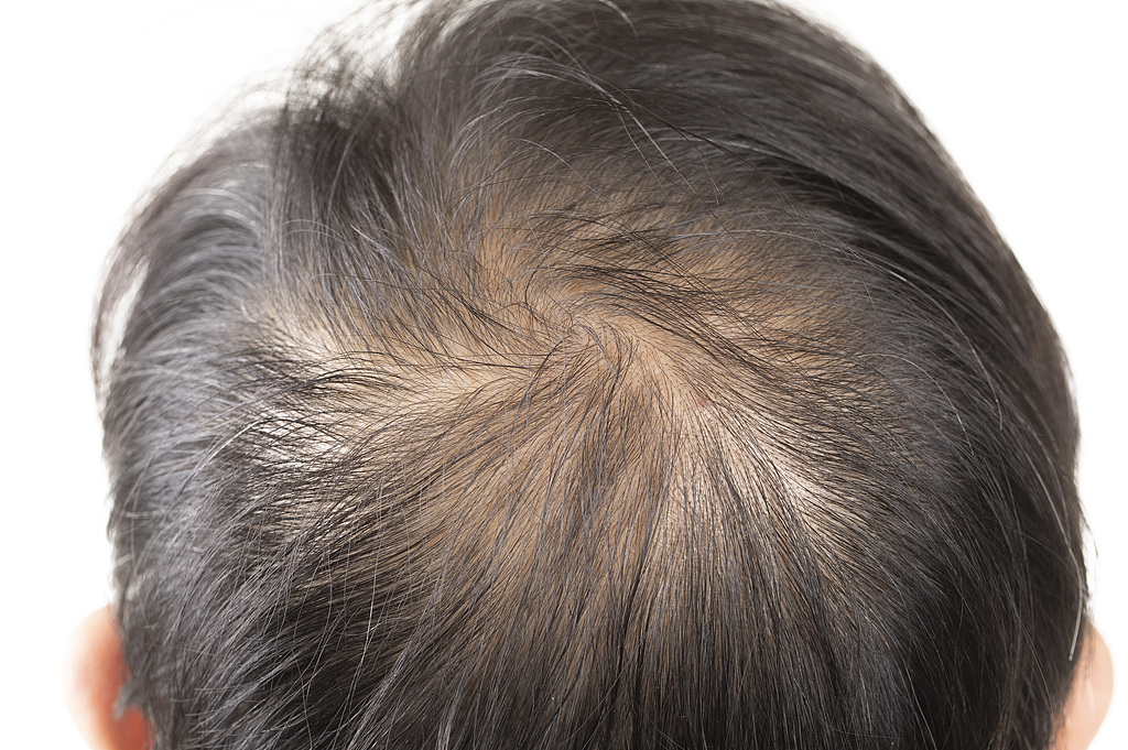 美媒：关键蛋白被发现或可逆转脱发