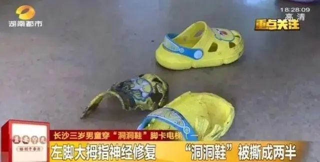女子常穿洞洞鞋致足底钙化行走困难！医生紧急提醒：选鞋牢记这几点插图1