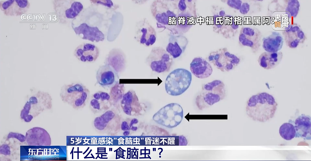 玩水会感染“食脑虫”？护鼻是关键插图1