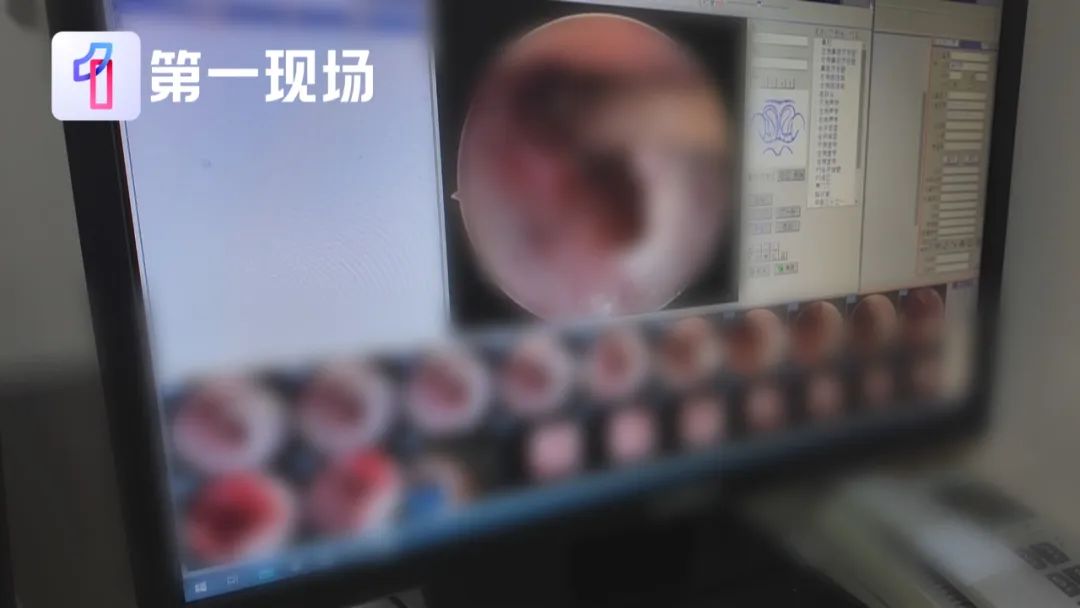 离奇！小伙脖子脓肿去医院，开刀发现里面有7颗瓜子插图