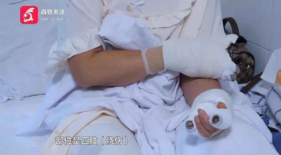 水里捡到的“石头”竟会自燃！女子三度烧伤插图2