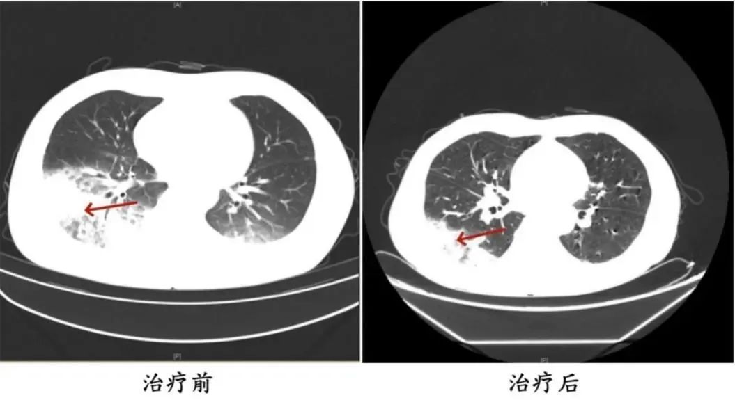 连吹3天空调致“白肺”，只因使用前忽视了这一点！插图