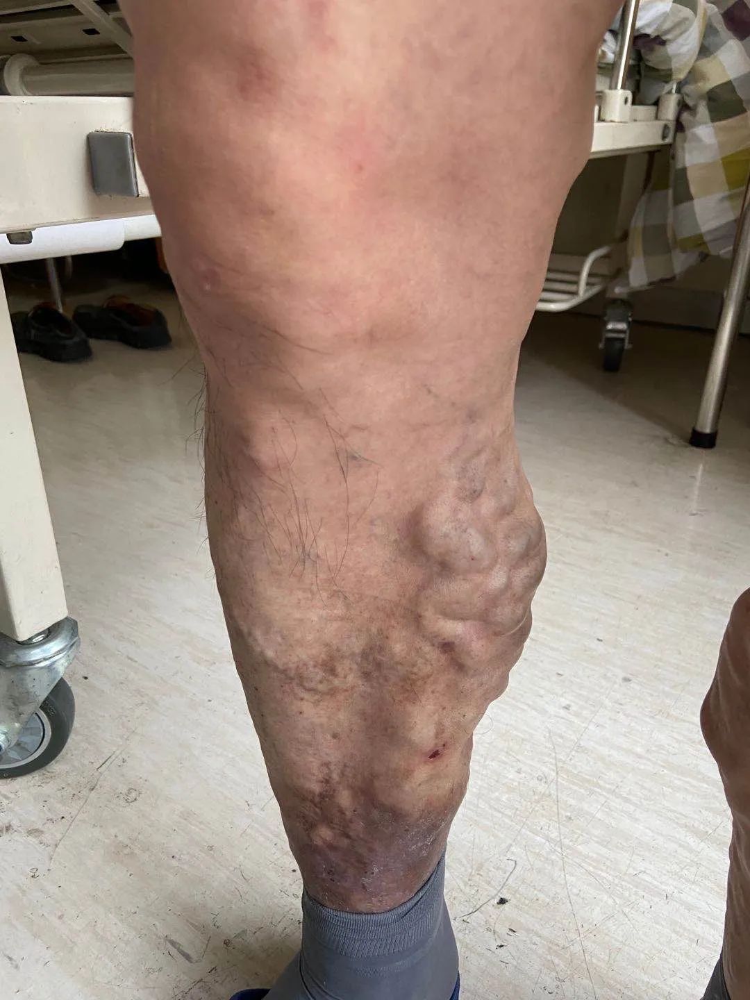 男子腿上多处长"蚯蚓",形状恐怖!几十年没穿过短裤