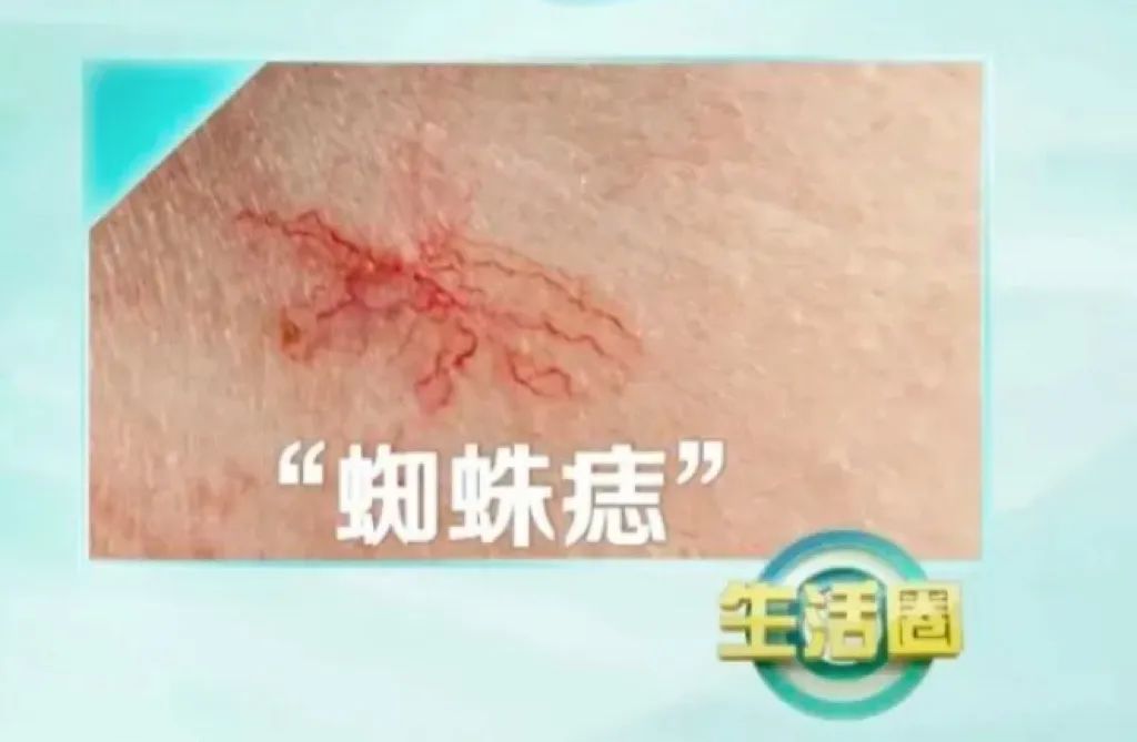 身上这3个部位出现红血丝，拖着不管该生病了插图