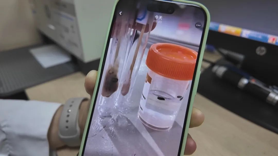 离奇！小伙脖子脓肿去医院，开刀发现里面有7颗瓜子插图2
