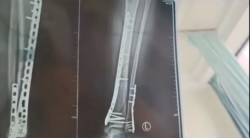 女子常穿洞洞鞋致足底钙化行走困难！医生紧急提醒：选鞋牢记这几点插图