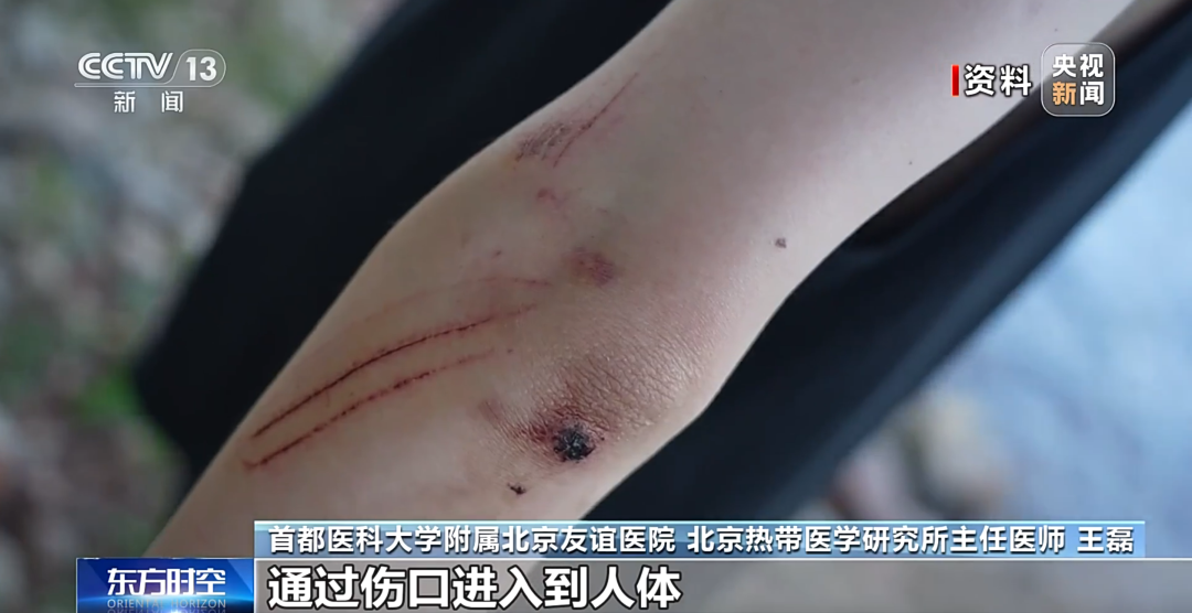 玩水会感染“食脑虫”？护鼻是关键插图4