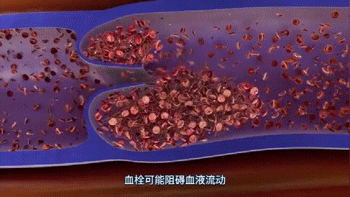 11小时飞行后，女子猝死！久坐引发的肺栓塞成了“沉默杀手”插图3