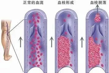 11小时飞行后，女子猝死！久坐引发的肺栓塞成了“沉默杀手”插图1
