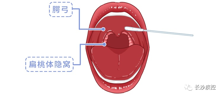 核酸检测咽拭子示意图图片