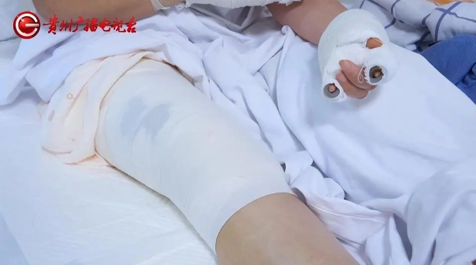 水里捡到的“石头”竟会自燃！女子三度烧伤插图4