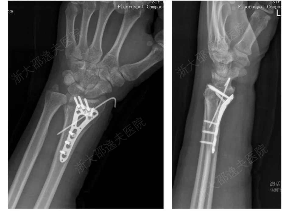 “骨胶水”来了，断骨黏合只需3分钟！