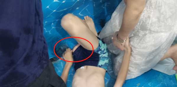 惊险！男孩整条左腿被泳池死死“咬住”插图1