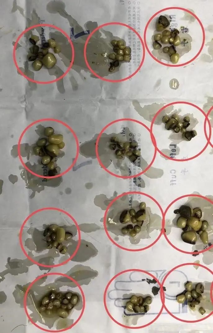 密密麻麻！湖北女子体内查出上千颗结石！医生提醒插图