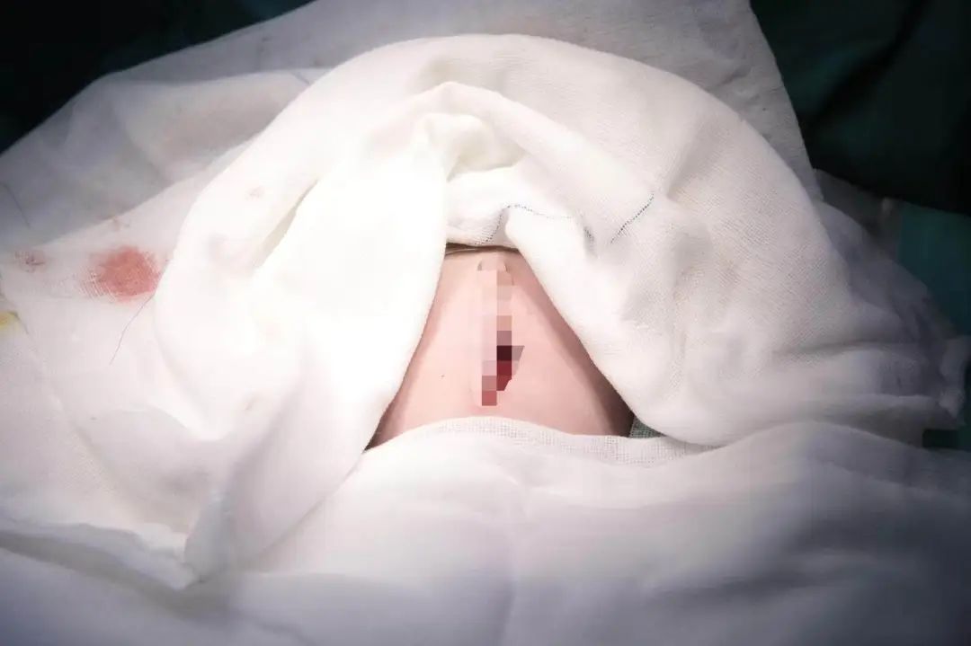 紧急！小肠、结肠全部暴露在外……宝宝出生26分钟进手术室，医生三小时紧急抢救插图4